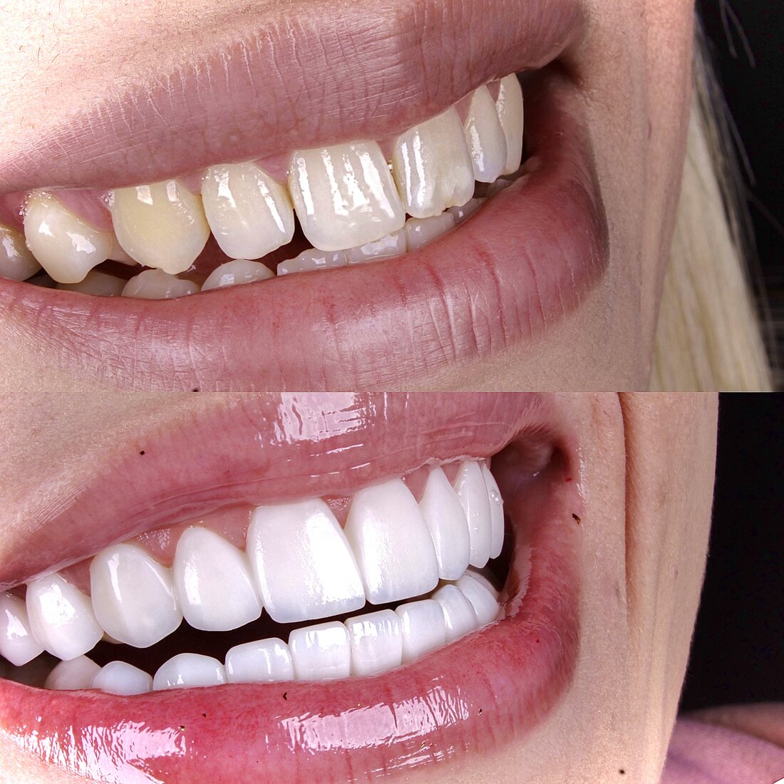Antes e depois — Lentes de resina composta Método Coy
