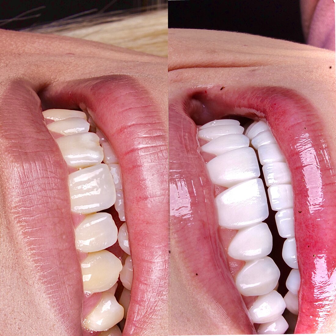 Antes e depois — Lentes de resina composta Método Coy