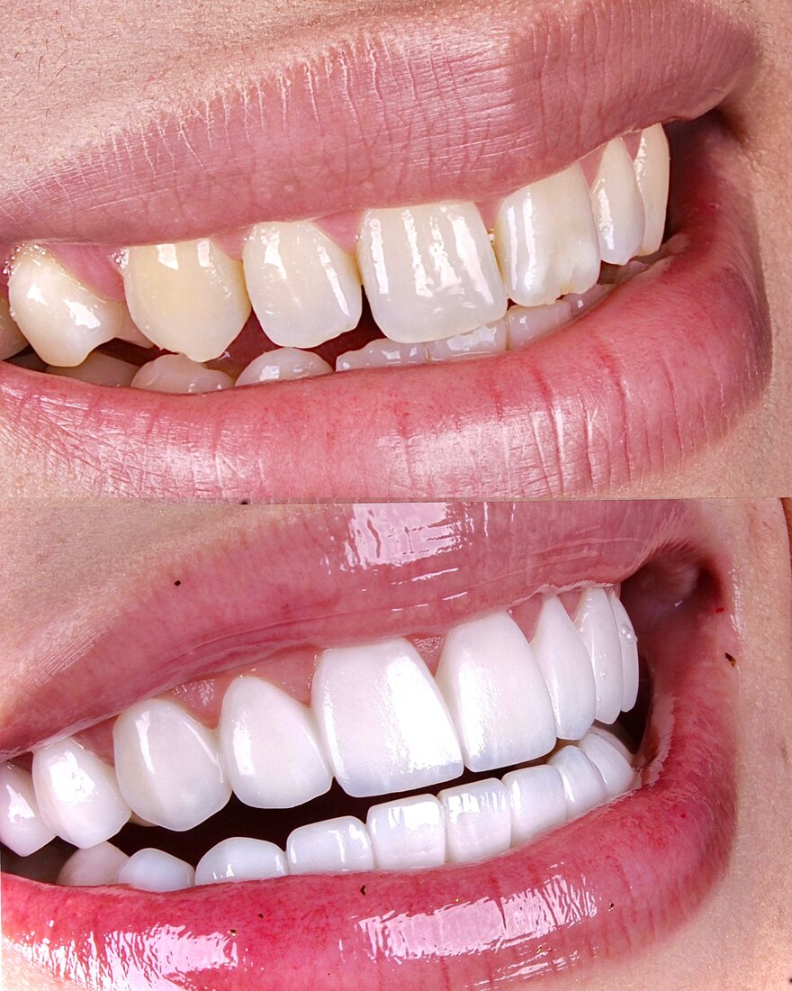 Antes e depois — Lentes de resina composta Método Coy